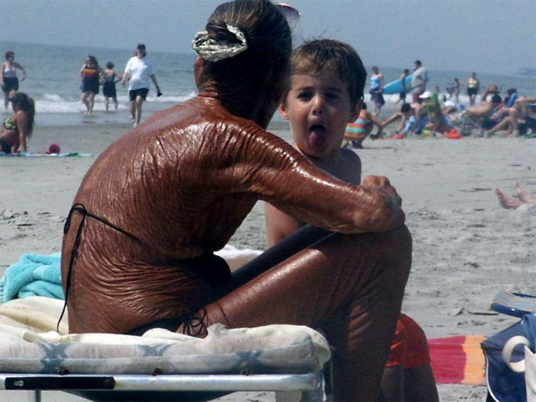 sunburn