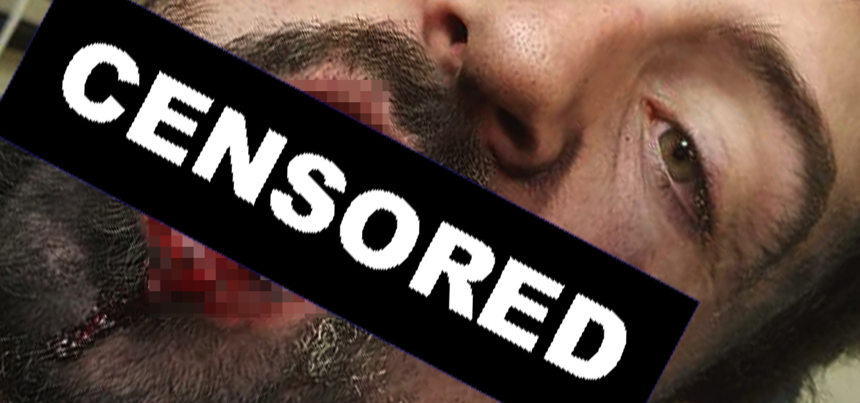 Начал вейпить – минус 7 зубов и сломанная жизнь (21+)
